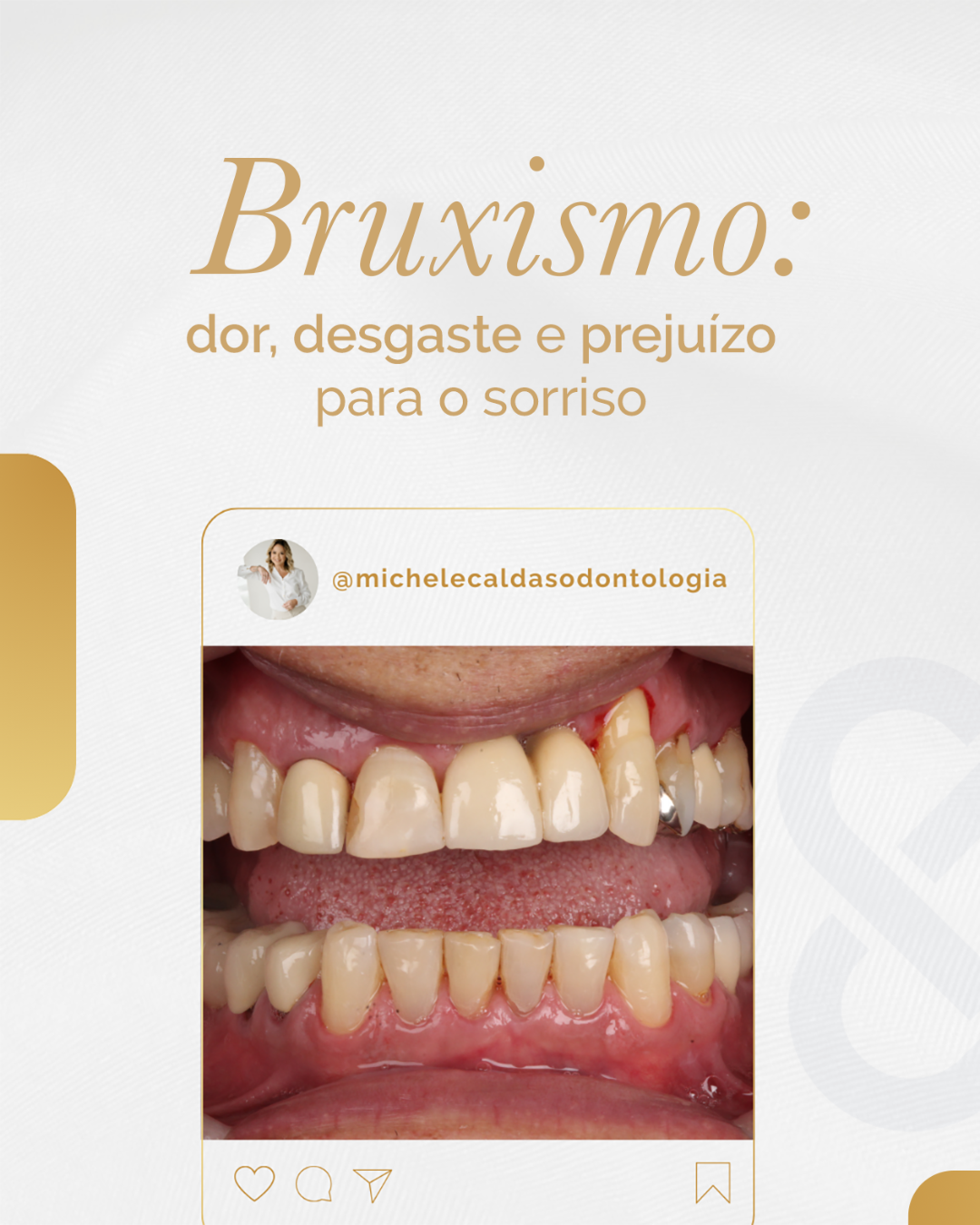 O bruxismo não afeta apenas os dentes: ele pode causar dor orofacial