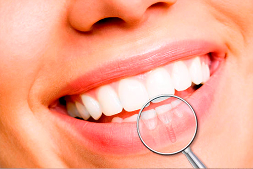 Impacto da Implantodontia na Odontologia e na vida das pessoas.