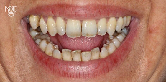 Por que os dentes escurecem com o tempo?