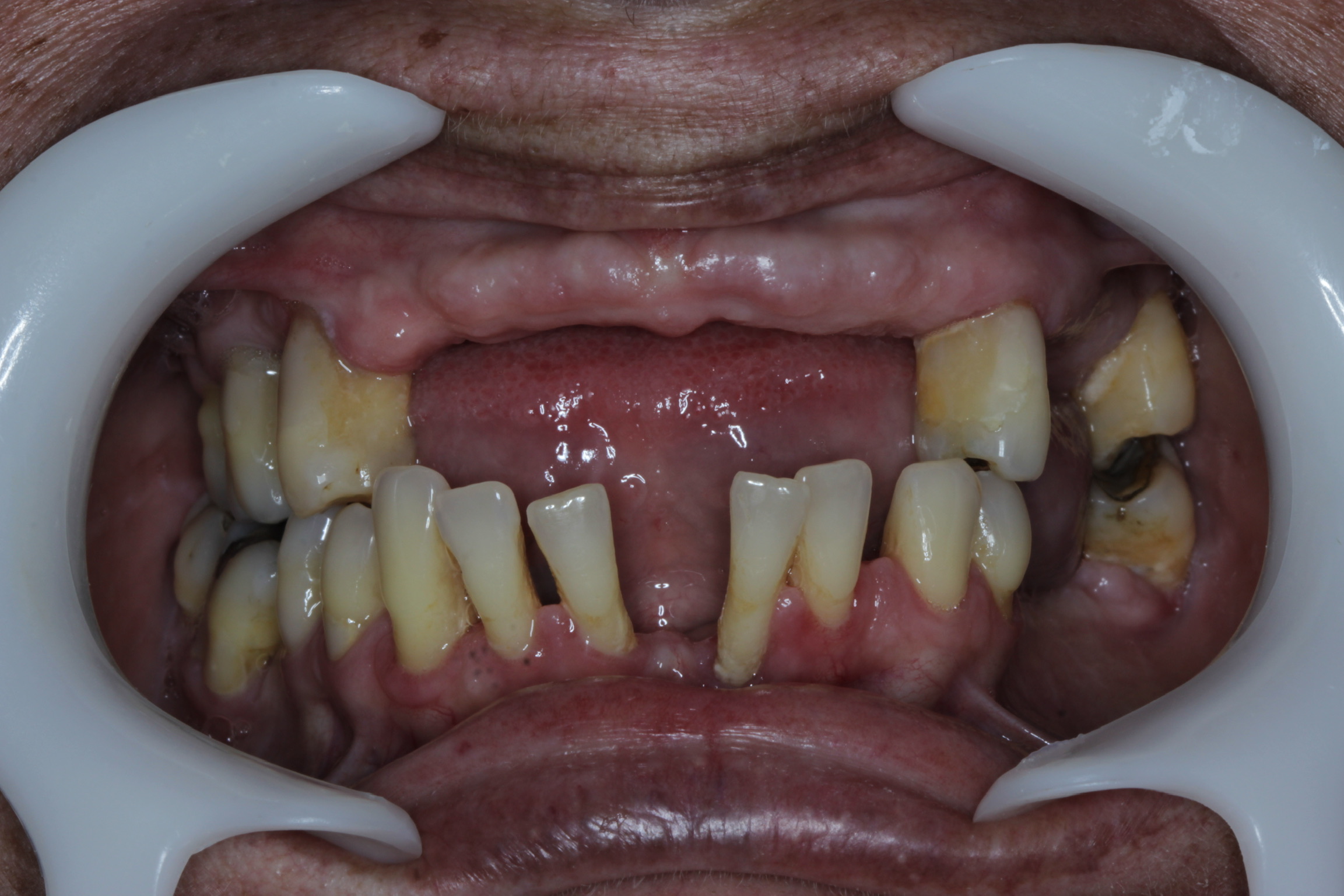 Ansiedade e estresse podem causar a perda dos dentes
