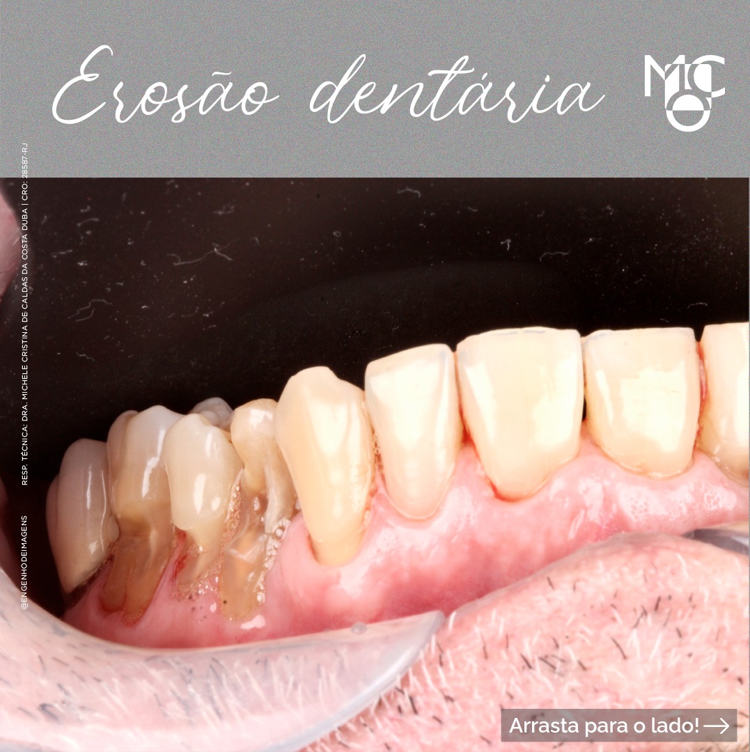 Você sabe o que é EROSÃO DENTÁRIA?