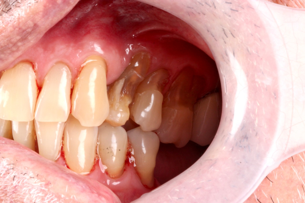 Erosão dentária ou bruxismo
