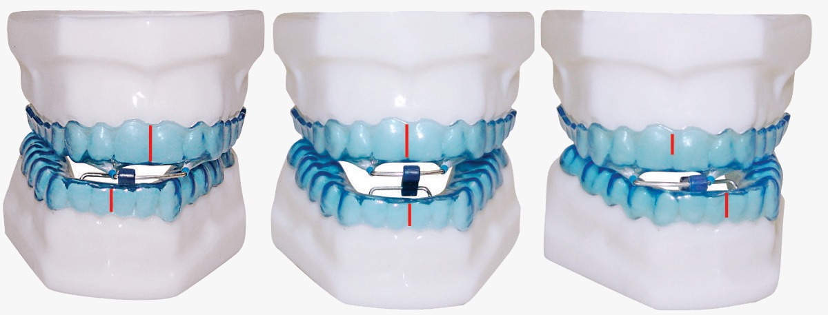 Novidade! Dispositivo intraoral
