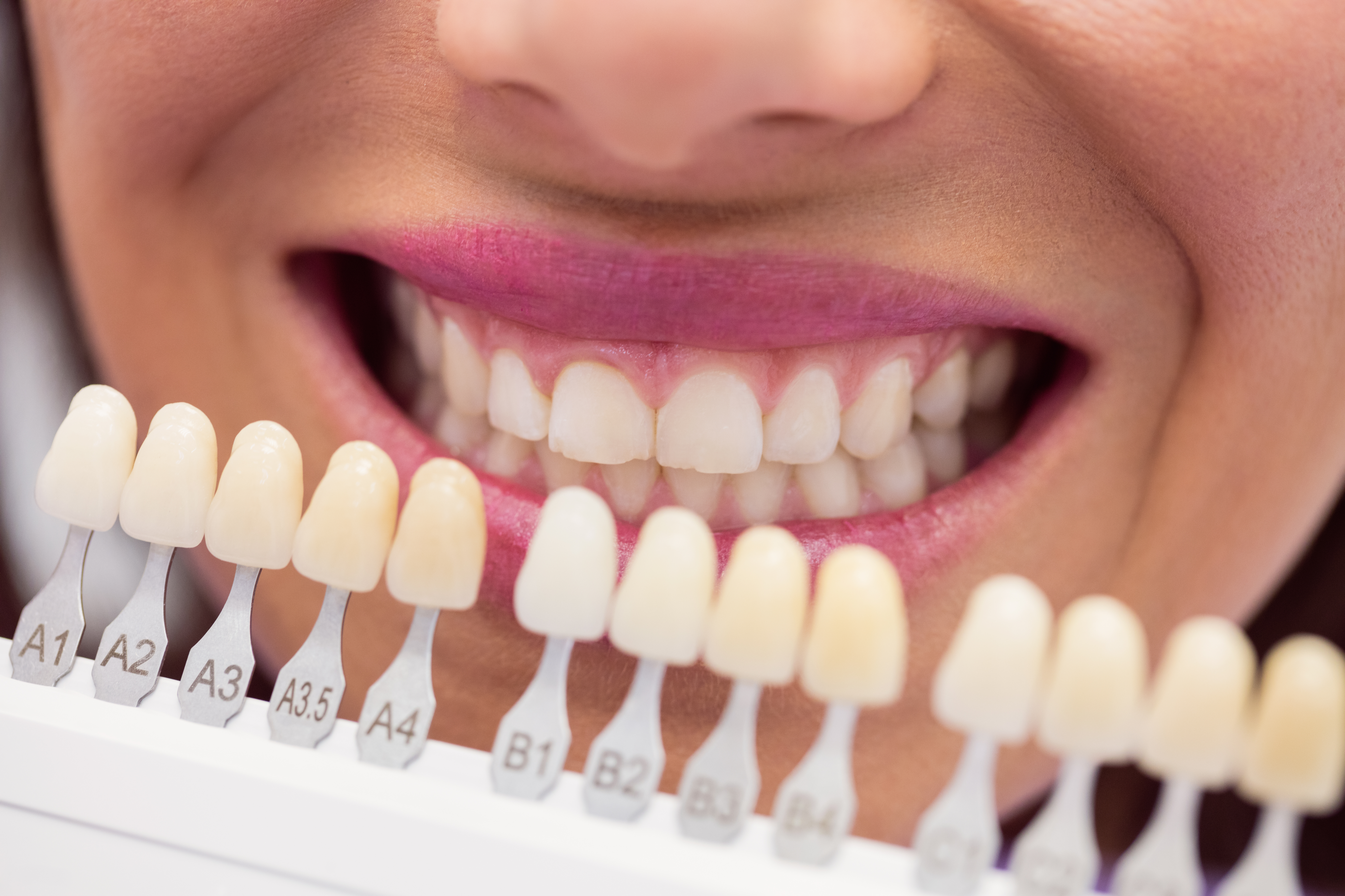 Facetas dentais e suas vantagens