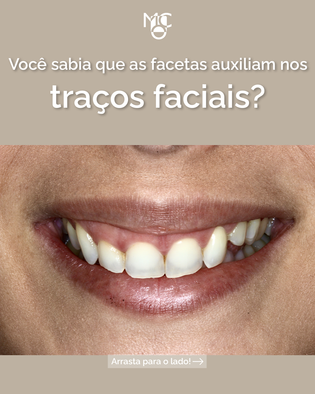 As facetas podem auxiliar nos traços faciais!